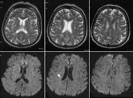 Marklagerveranderungen Bei Neurodegenerativen Und Vaskularen Demenzerkrankungen Springerlink