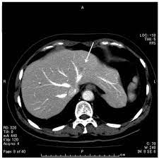 Unenhanced Ct Scan Showed Low Density Area Of 1 Cm In Diameter In The Download Scientific Diagram
