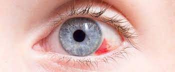 Geplatzte Ader Im Auge Wie Gefahrlich Ist Es