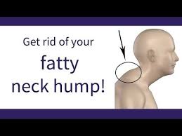 Forward Head Posture 30 Day Posture Makeover Youtube Posture Exercises Neck Exercises Forward Head Posture