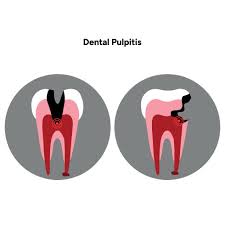 Image result for Pulpitis