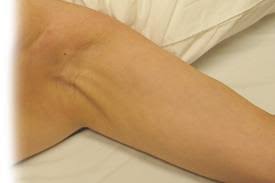 Axillary Web Syndrome Lymphedema Blog