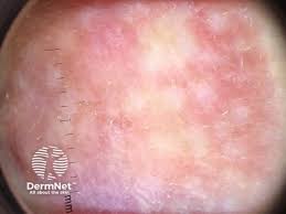 Image result for Dermatofibrosarcoma Protuberans