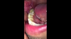 Dry Socket Wisdom Teeth Stitches Novocom Top