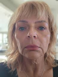 Picked a surgeon! Scheduled for March 12th. DP FL/NL, browlift with fat  transfer. Picking the surgeon is the hardest! I came across several  surgeons that I was impressed with! Nervous now about