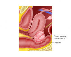 Ia biasanya tidak menunjukkan sebarang tanda tertentu. Bab 2 Fibroid Rahim Melaka Fertility Selva S Fertility Obstetrics And Gynaecology Clinic