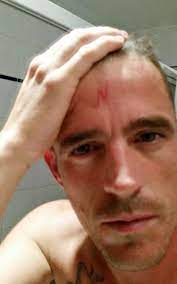 Drunk People Are Now Getting Harry Potter Lightning Bolt Tattoos On Their Foreheads