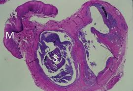 Image result for Sialolithiasis