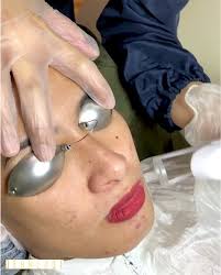 Clarity InnerLift , A laser treatment helps to improve the look and tone of  skin. It increases skin elasticity, softens fine lines and gives the skin  an overall glow., • Pore tightening, • Acne ...