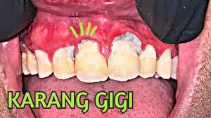 Karang gigi in a sentence and translation of karang gigi in english dictionary with audio pronunciation by dictionarist.com. Dokter Gigi Tri Putra Youtube Channel Analytics And Report Powered By Noxinfluencer Mobile