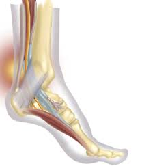 Can Orthotics Have An Impact On Tarsal Tunnel Syndrome Podiatry Today