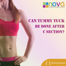 When Can You Have A Tummy Tuck After C Section Tummy Tuck Abdominoplsty Tummy Tucks Tummy Tuck Surgery Abdominoplasty