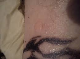 Wann sie wieder ins schwimmbad dürfen. Blase Uber Tattoo Gesundheit Medizin Menschen