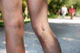 Varicose Veins And Blood Clots In Your Leg The Iowa Clinic