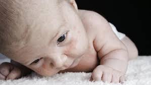 Halakan mukanya pada wap air tersebut. Cara Menghilangkan Milia Pada Bayi Secara Alami