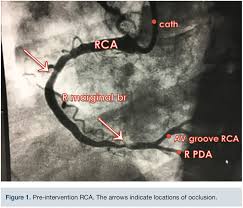 Contribution from both the rca and left circumflex artery. Anomalous Left Main Coronary Artery In A Stemi Patient Cath Lab Digest