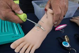 Image result for Fishhook Removal