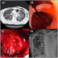 Image result for Pulmonary Contusion