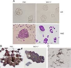 Some cancers, such as leukemia, do not form tumors. Cd44hicd24lo Mammosphere Forming Cells From Primary Breast Cancer Display Resistance To Multiple Chemotherapeutic Drugs