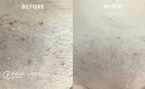 It is very important to know where to get brazilian laser hair removal. Brazilian Laser Hair Removal Pulse Light Clinic London