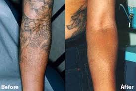 It's been 3 months and it's still dark brownish red. Tattoo Removal Royal Tunbridge Wells Kent Uk