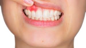 Gum abscesses are slightly different to dental abscesses, though they may share some of the same symptoms and treatments. What Is A Dental Abscess And How Do I Know I Have One Yorkhill Endodontics
