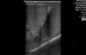 Image result for Cremasteric Reflex