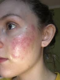 This picture shows how the burn looks five weeks after the injury. Pin On Lactic Acid Peel