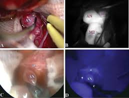 Endoscope Integrated Indocyanine Green Video Angiography For Cerebral Aneurysm Surgery A More Effective Technique In Innovative Neurosurgery Volume 3 Issue 3 4 2015 It is possible that as the aneurysm enlarges and compresses surrounding nerves or organs, an individual may experience back or abdominal pain.