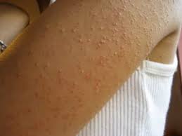 If you've noticed tiny little rough bumps on your arms that look like pimples, it might not be regular old acne. A Dermatologist S Tips For Managing Keratosis Pilaris Kp Skincare Physicians