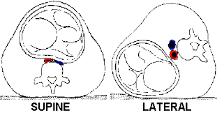 The Preferred Position For Pregnant Women Is In Semi Fowlers On Left Side To Prevent Vena Cava Compression If The Future Nurse Medical Studies Student Midwife