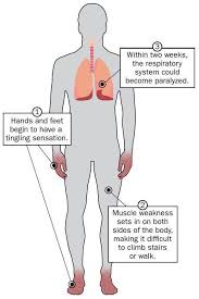 Pathogenesis, diagnosis, treatment and prognosis neurol. Symptoms Of Guillain Barre Syndrome About Guillain Barre Syndrome