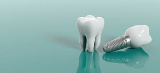 Dental implants are titanium posts that are inserted into your bone and act like the roots of your teeth. Grants Or Financial Help For Dental Implants