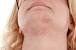 Hair Bumps On Chin Female