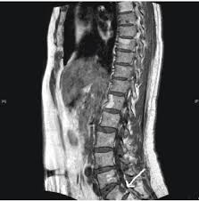It can be challenging to treat and often has a poor prognosis. Metastasis Oseas Multiples De Cancer De Mama Papel Del Ca 15 3 Y Respuesta A La Hormonoterapia