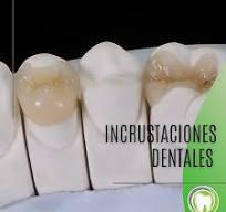Conoces las Incrustaciones Dentales? 🤔😁 Una Incrustación ...