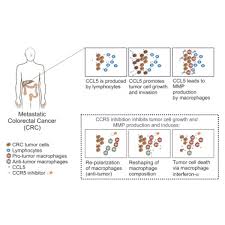 Bowel cancer, sometimes called colon or rectal cancer, is a general term for cancer that begins in the large bowel. Tumoral Immune Cell Exploitation In Colorectal Cancer Metastases Can Be Targeted Effectively By Anti Ccr5 Therapy In Cancer Patients Cancer Cell