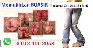 Preperation h berfungsi untuk menenangkan dengan mengecilkan saluran darah secara sementara di sekitar kawasan sapuan untuk mengurangkan bengkak, keradangan, kesakitan dan ketidakselesaan. Meorbio Info Buasir Info Jenis Jenis Buasir Peringkat Tahap Keterukan Cara Rawatan Pemulihan Dan Bukti Kesahihan