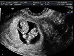 At this stage in a fetus' life its impossible to determine whether the twins are fraternal or identical. 7 Week Ultrasound Identical Twins Image Gallery Twins Ultrasound Ultrasound 10 Weeks Pregnant Ultrasound