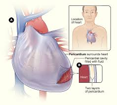 Myocarditis is inflammation of the heart muscle, and pericarditis is inflammation of the outer lining of the heart. Pericarditis Heart Health Medical Pllc