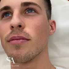 Scott d allison is a indianapolis, indiana based male optometrist who is specialized in optometry. Dr Scott Allison Cosmetic Physician Doctor Newstead Queensland 99 Photos Facebook