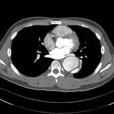 It is difficult to diagnose these tumors clinically and radiologically, and they can finally be confirmed through pathological examination with immunohistochemistry. 13 Ct Lung Ideas Radiology Radiology Imaging Radiography