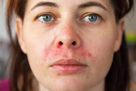 Image result for Seborrheic Dermatitis