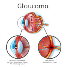 Image result for Glaucoma
