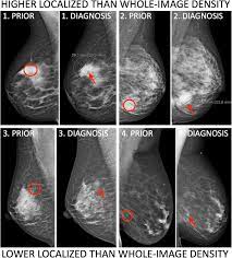 Not all of the tumors found by mammography can be cured. Localized Mammographic Density Is Associated With Interval Cancer And Large Breast Cancer A Nested Case Control Study Breast Cancer Research Full Text