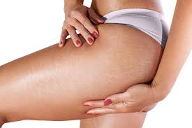 Learn about our laser treatment for stretch marks and scars using advanced co2 laser technology how can you improve the appearance of stretch marks? Stretch Marks Removal How Can You Get Real Results
