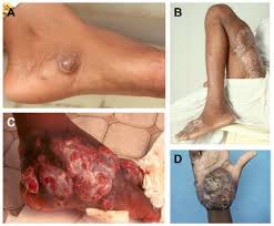 Learn how to treat them. Mycetoma Epidemiology Treatment Challenges And Progress Rrtm