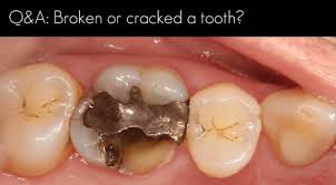 Learn potential causes, common symptoms & treatment options. Broken Tooth Or Cracked Teeth Windsor Dentists