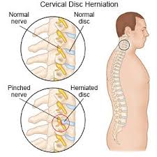 This maneuver helps keep the spine flat. Cervical Disc Herniation What You Need To Know
