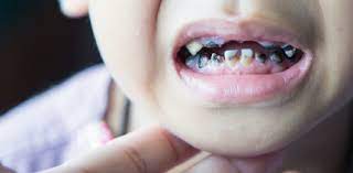 Vernachlassigte Milchzahne Zahnarzte Schlagen Alarm Zwp Online Das Nachrichtenportal Fur Die Dentalbranche